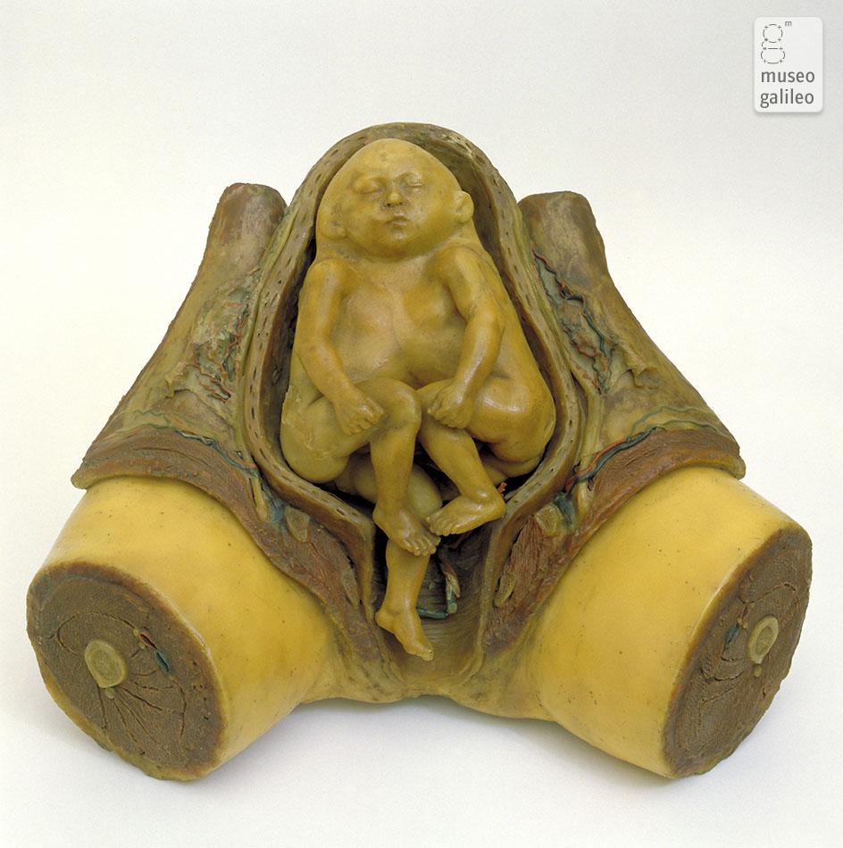 Model of malformed fetus (Dep. OSMN, Firenze)